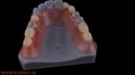 3D Print Model High Esthetics Dental TCS Valplast Flexible Partial Dentures