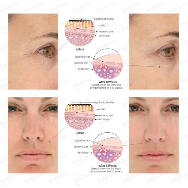 7 Color 15w Output Power Pdt Led Light Therapy Machine Blue Light