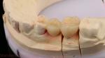 Dental Digital Full Zirconia Crown With 3D Print Model SDL Dental Lab Zirconia