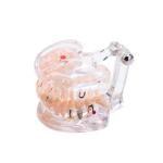 32 Tooth Full Month Implant Disease Teeth Model Clear Design Dental Pathology