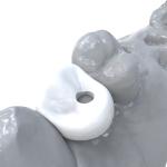 Permanent Crown Resin Bending Modulus 4500 Mpa Shore D 92 for Dental Restoration