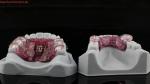 Teeth Expansion And Distalization Adjusting Expander In Mouth Orthodontist