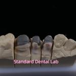 Metal Cast Post Core Crown Cocr Accurate Retentive Full Zirconia Bruxier