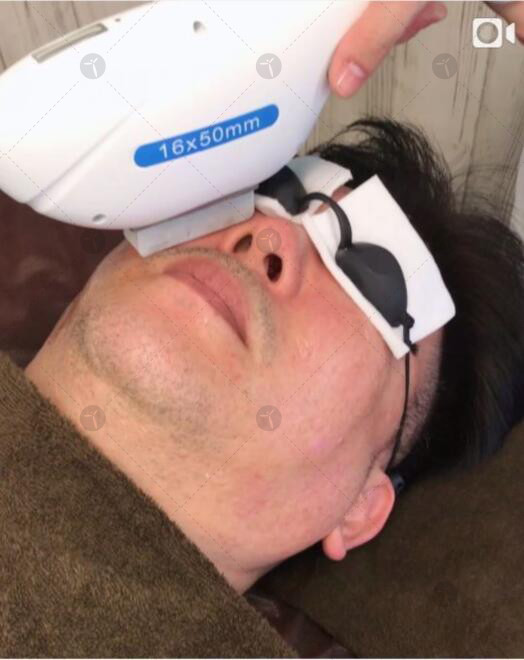 Vertical Multifunction Shr Ipl Hair Removal Machine Acne Treatment