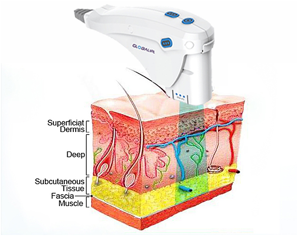 Wrinkle Removal Face Lifting HIFU Machine Non Invasive With 3 Cartridge