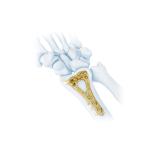 Medical Orthopedic Multi-Axial Distal Radius Medial Locking Plate