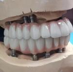 Precision-Crafted Zirconia Implant Screw Cement Retained for Natural-Looking