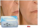 Hyaluronic Acid Injectable Filler 10ml For Lip Injection Cheeks Chin Augmentatio