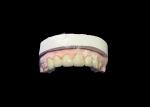 Biocompatible Porcelain Fused To Metal Crown High Durability For Enhanced