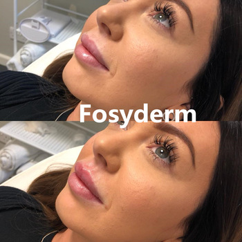 Transparent 1ml Sexy Lips Hyaluronic Acid Derm Line Gel Dermal Lip Fillers