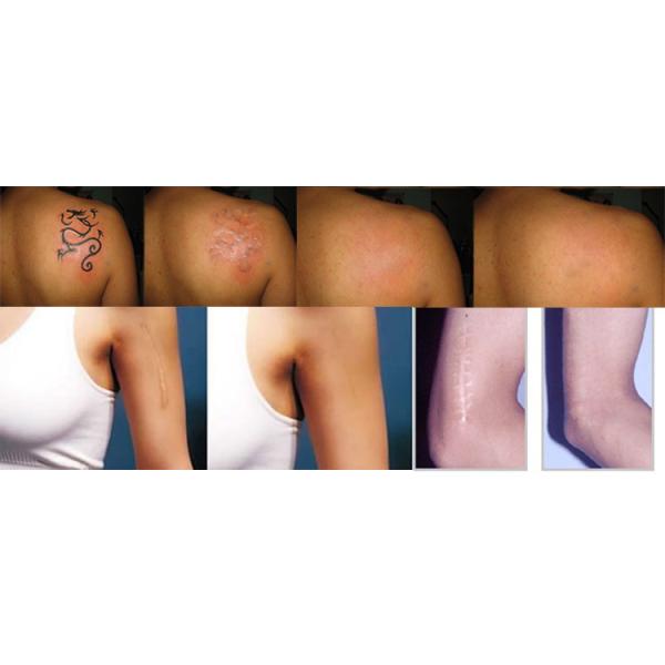532 Nm 1064 Nm Q Switch Laser Tattoo Removal Equipment Continuously For 18 Hours