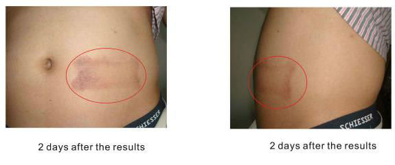 Non Invasive Body Contouring Machine , Body Freeze Machine Remove Surplus Fat