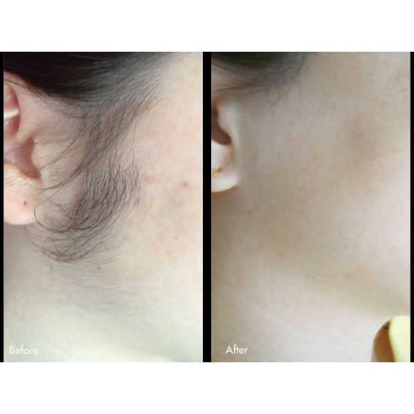 Skin Rejuvenation IPL Laser Hair Removal Machine With One Piece IPL SHR Handle