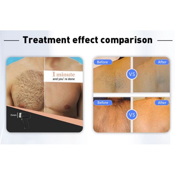 Hair Laser Removal Diode Laser with 3 Wavelengths 15.6 inch Color Touch Android Screen