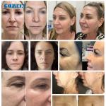 Morpheus 8 Face Lift Beauty Gold Microneedling Machine Skin Rejuvenation For