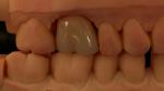 Mill and Centring Full Zirconia Crown , China Dental Lab Fast Delivery