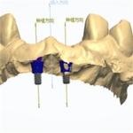 Precise CAD/CAM Design Zirconia Dental Crown for Fitment