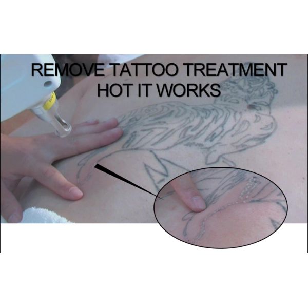 Picosecond Q Switched Nd Yag Laser Professional Pigments Removal Machine