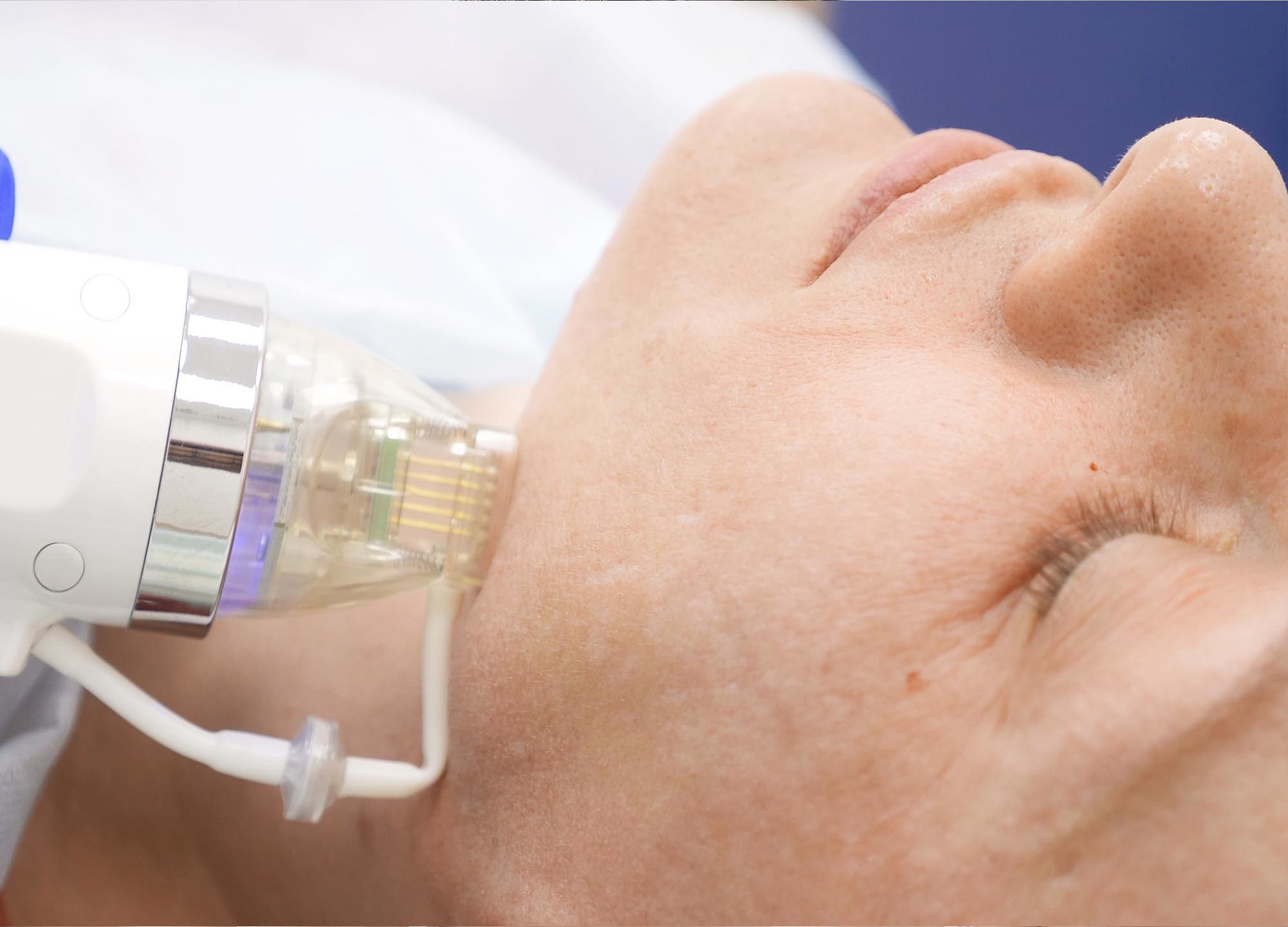 Stretch Mark Rf Fractional Machine Iso Approved
