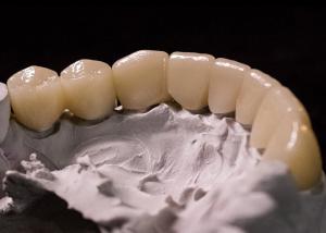Wholesale Porcelain Fused to Metal Crowns - Advanced Technology for Long Lasting Smile Restoration from china suppliers