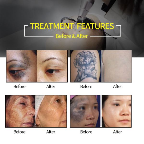 Picosecond Q Switch Nd Yag Pixel Laser Machine Pigmentation Removal