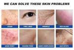 2mj~150mj Er Yag Laser Machine Stretch Mark Removal Laser Machine For Skin