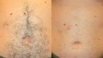 Triple wavelength diode laser machine fro hair removal