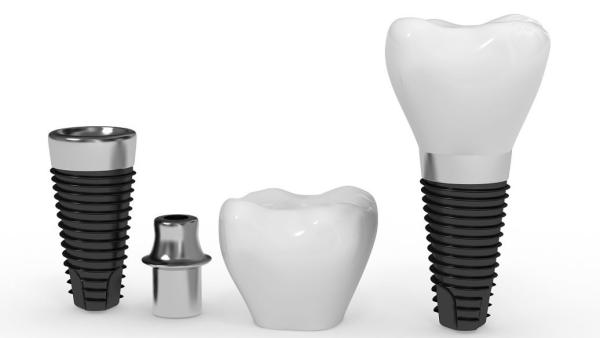 Safe Reliable Artificial Root Implant Long Service Life Natural Dental Implant