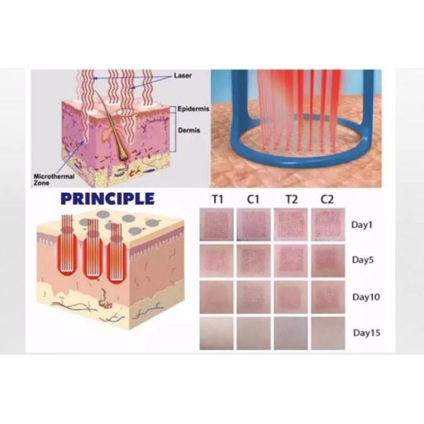 CO2 Fractional Laser Device with Touchscreen Interface for Advanced Skin Therapy Wrinkle Removal and Lifting